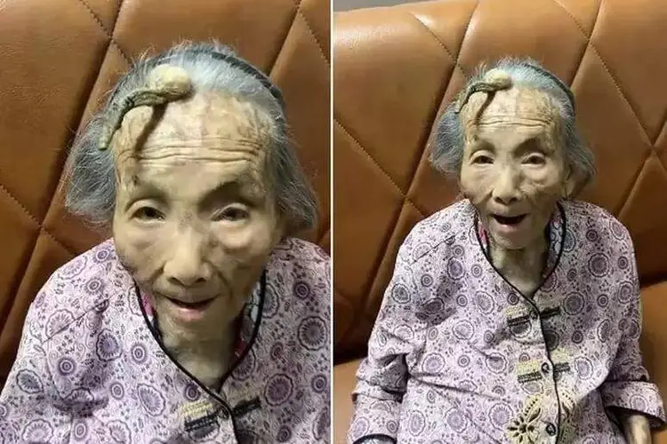 Idosa de 107 anos com chifre