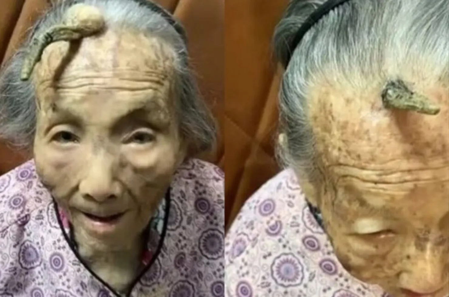 Idosa de 107 anos com chifre