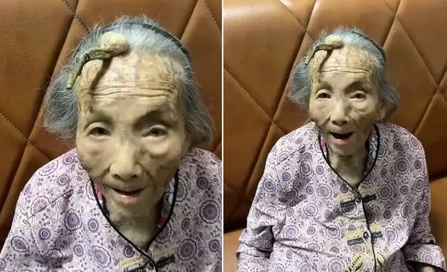 Idosa de 107 anos com chifre