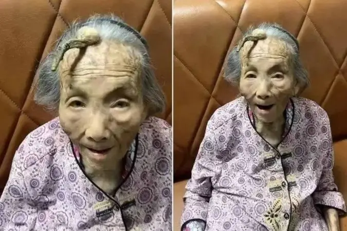 Idosa de 107 anos com chifre